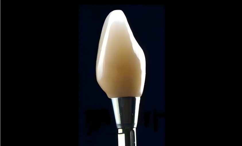 Implant  single  crowns